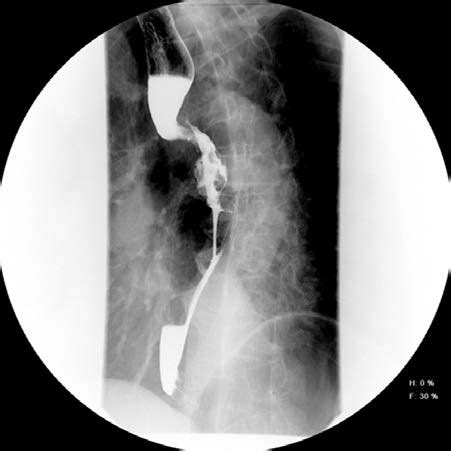 cpt code for xr esophagram