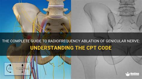 cpt code genicular radiofrequency ablation