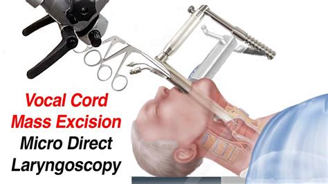 Cpt Code Microdirect Laryngoscopy With Biopsy