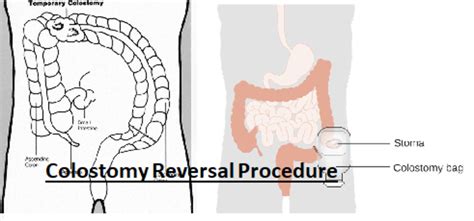 Cpt Code Ostomy Reversal