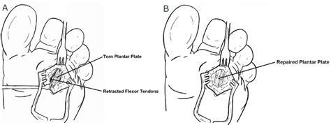 cpt code plantar plate repair