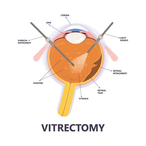 cpt code retinal detachment repair vitrectomy