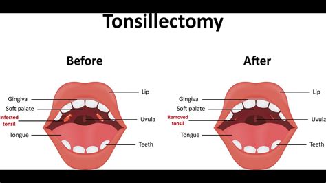 cpt for tonsillectomy
