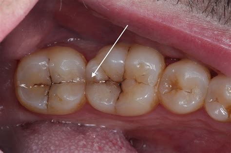 crack in back tooth