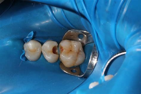 cracked filling toothache