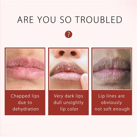 cracked lips dehydration