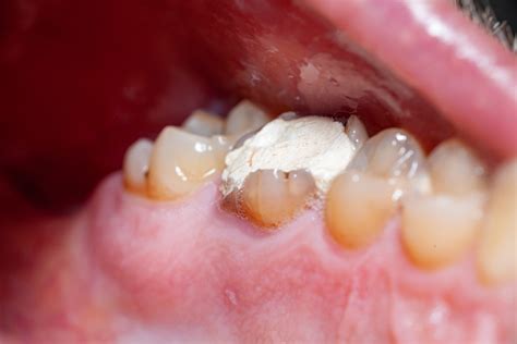 cracked tooth temporary filling
