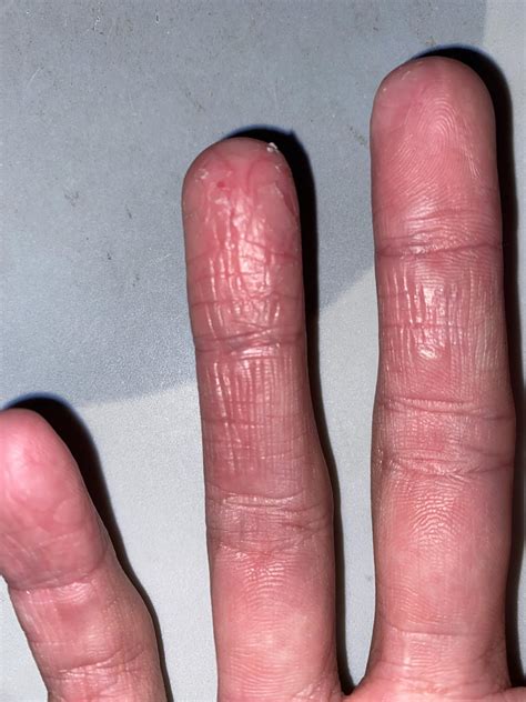 Cracking Fingers Effects