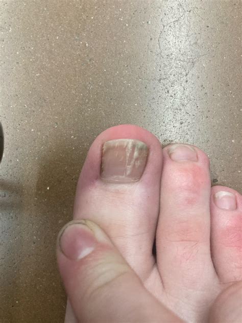 cracking toe nails