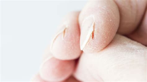 cracks on fingertips