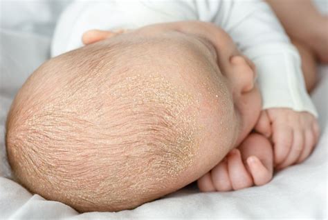 Cradle Cap Duration