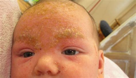 Cradle Cap In Eyebrows