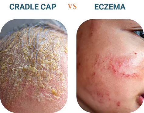 Cradle Cap Vs Psoriasis