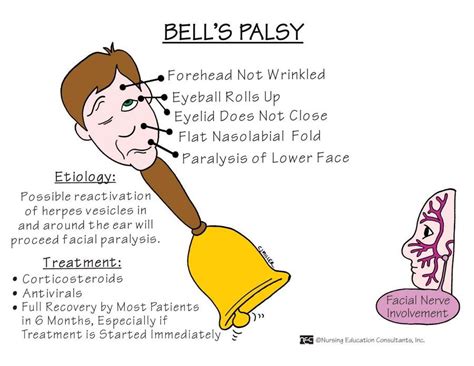 cranial nerve involved in bell's palsy