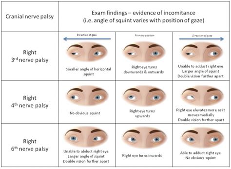 cranial nerve palsy testing