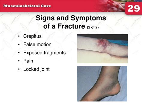 crepitus and false motion are