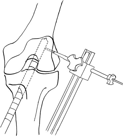 Cross Pin Fixation Technique