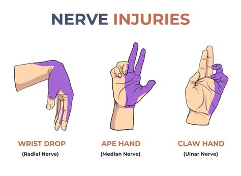 Crushed Hand Nerve Damage