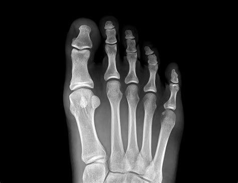 Crutches For Fractured Toe