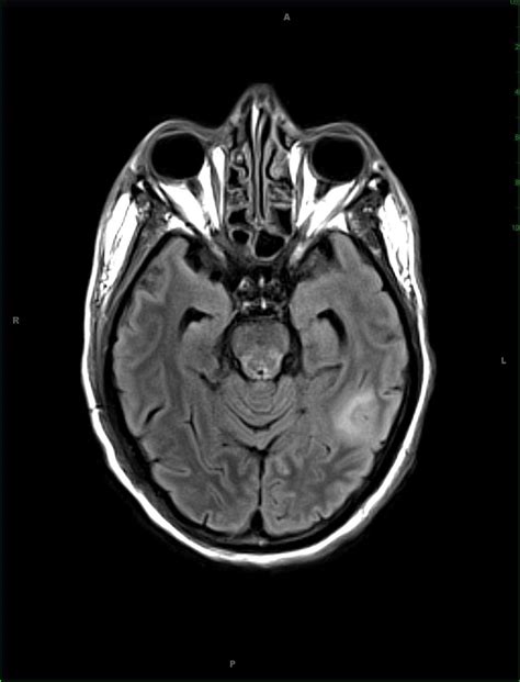 cryptococcal meningitis ct scan