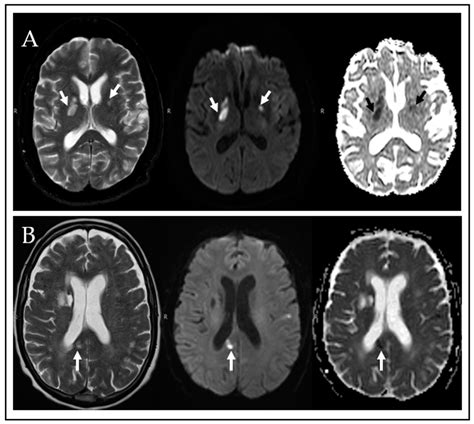 cryptococcal meningitis in non hiv patients