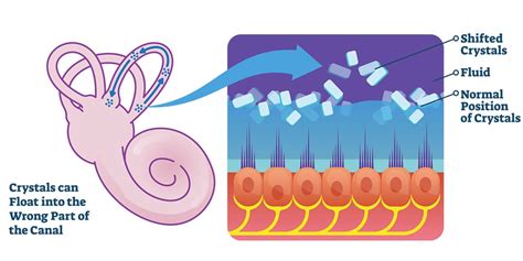 Crystals In Ear Canal Causing Vertigo