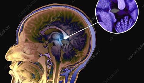 Ct Scan Showing Pineal Gland Pineoblastoma Wikidoc
