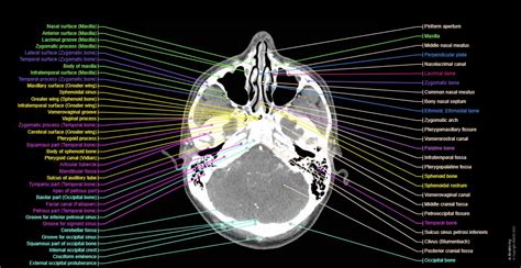 Ct Anatomy Of Head
