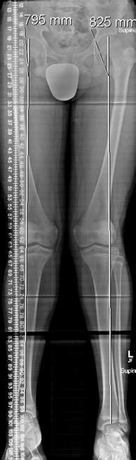 ct bone length study