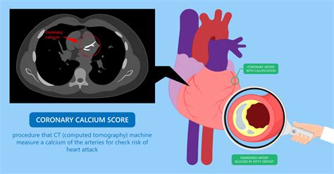 Unlock Heart Health: What is a CT Calcium Scoring Test?