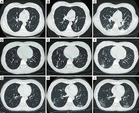 Understanding the CT of Chest: What You Need to Know About This Vital Diagnostic Test