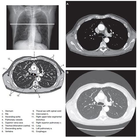 Understanding CT Scan for Chest: What You Need to Know About This Vital Diagnostic Tool