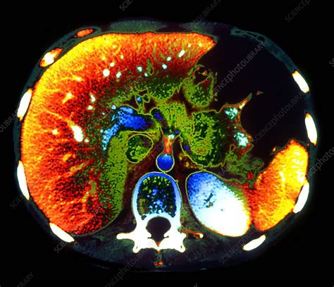 Ct Scan Liver