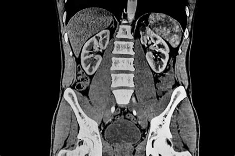 Understanding CT Scan of Abdomen: Diagnosis and Insights Revealed