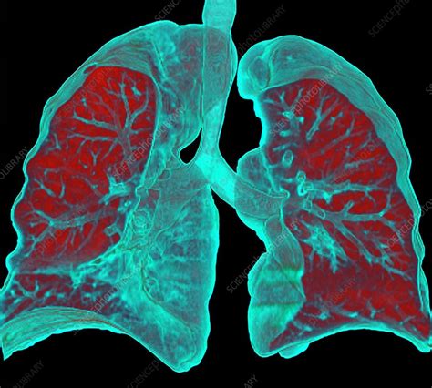 Understanding Lung Health: What Does a CT Scan of Lungs Reveal?