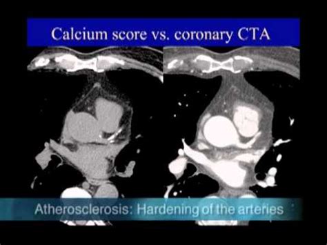 ct vs cta difference
