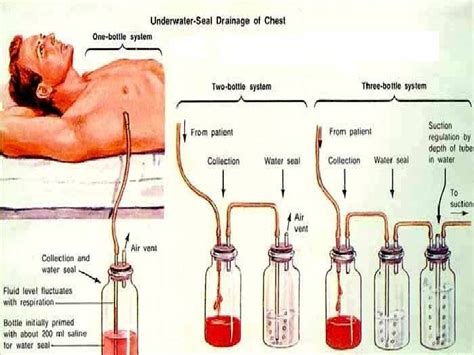 ctt meaning in medical