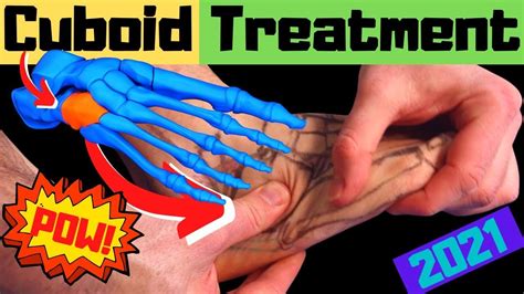 cuboid bone pain relief