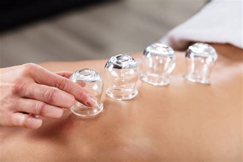 Cupping En Acupuncture