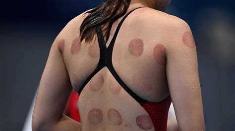 5 Ways Cupping Helps Swimmers