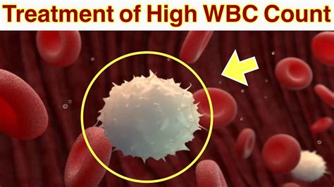 cure for high wbc count