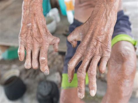 cure for leprosy discovered