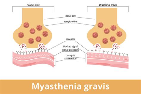 current research on myasthenia gravis