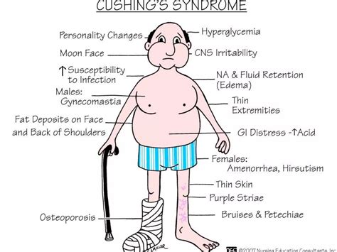 Cushing's Disease Presentation