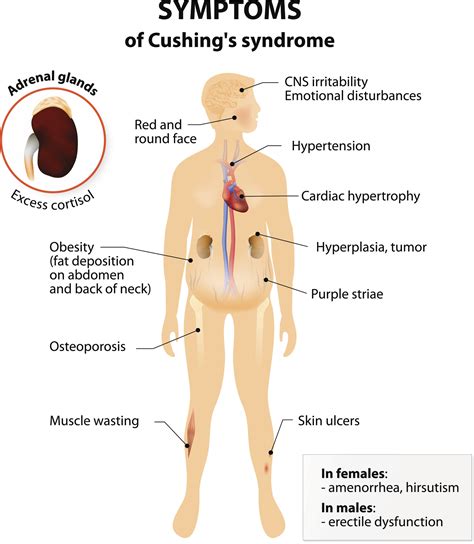 Cushing Disease Brain