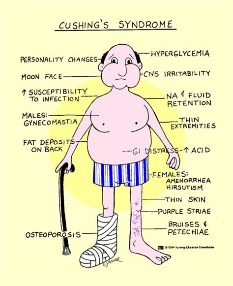 Cushing Syndrome Reversible