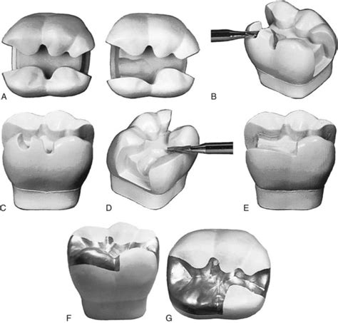 Cusp Capping Amalgam