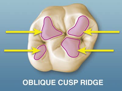 Cusp Ridge Dentistry Definition