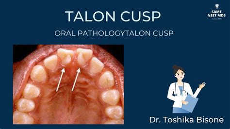 Cusp Tooth Example