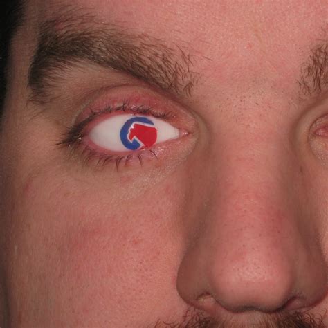 Custom Prosthetic Eye Designs